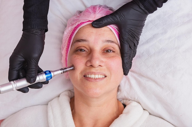 Mezoterapia bezigłowa jak często powtarzać żeby osiągnąć najlepsze efekty?